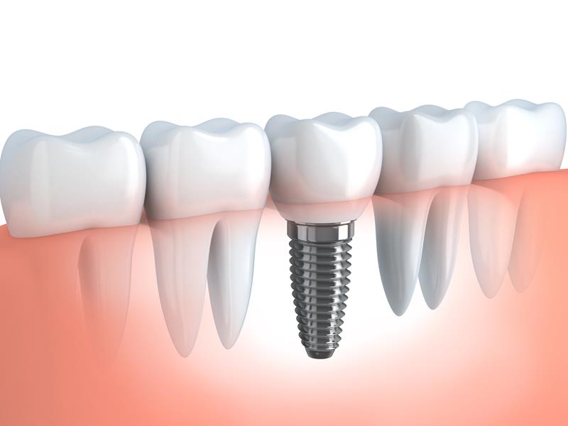 Dental Implants Belleville, IL 